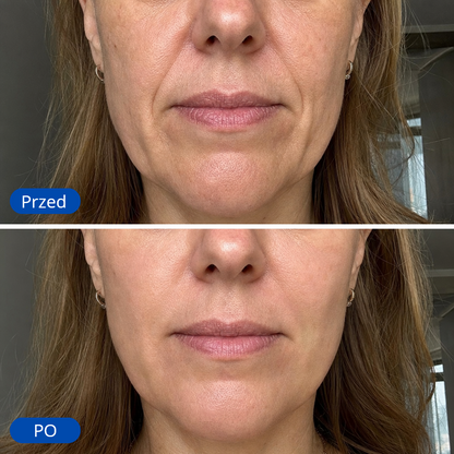 Ceralisse | Serum z botoksem