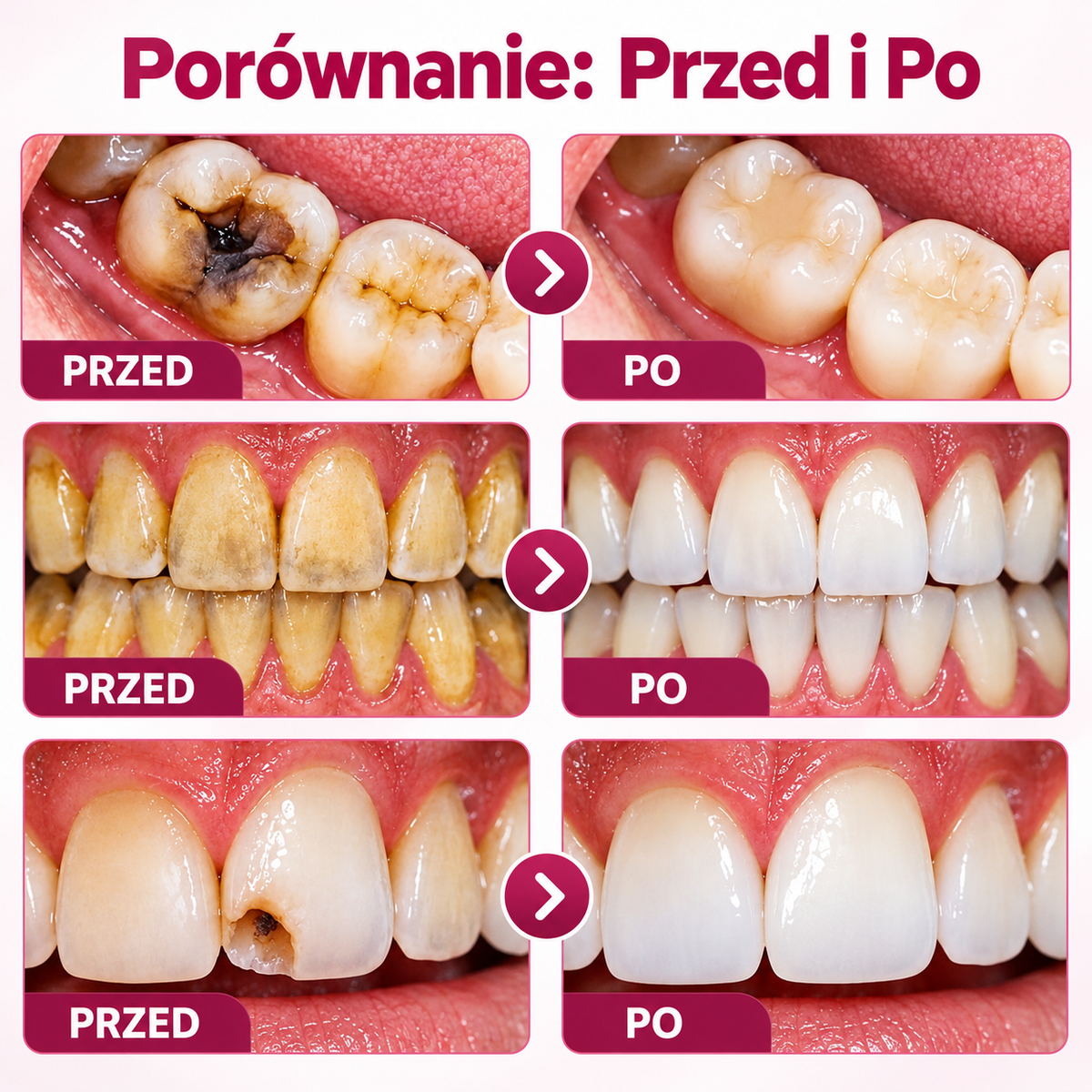 DentiPro |  Żel do naprawy zębów